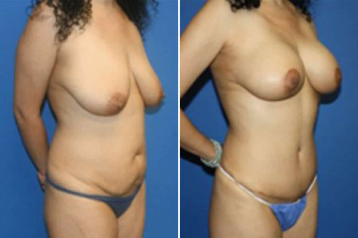 Mommy Makeover Before and After Photos in New York, NY, Patient 11060