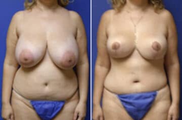 Mommy Makeover Before and After Photos in New York, NY, Patient 11069