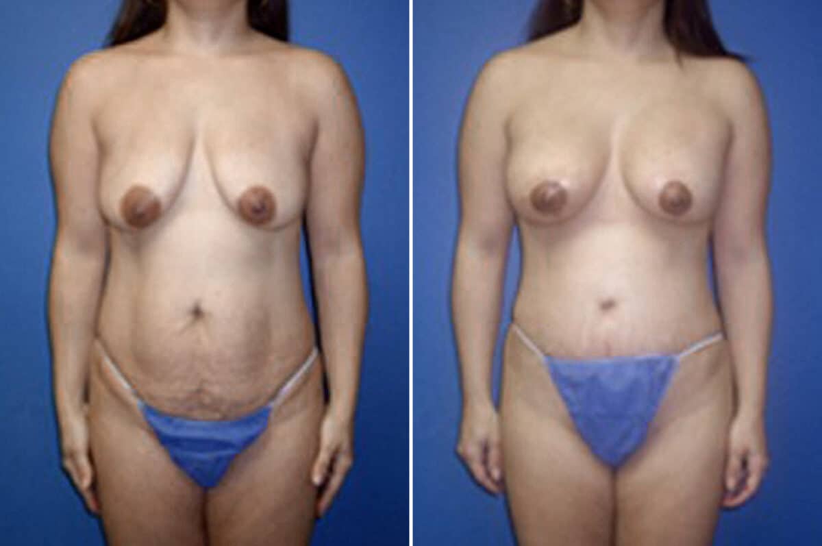 Mommy Makeover Before and After Photos in New York, NY, Patient 11072