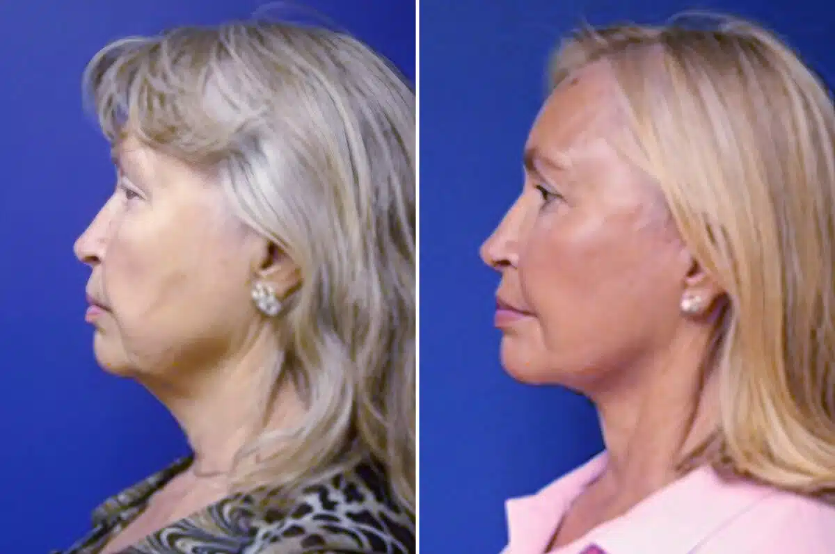 Facelift Before and After Photos in New York, NY, Patient 11307