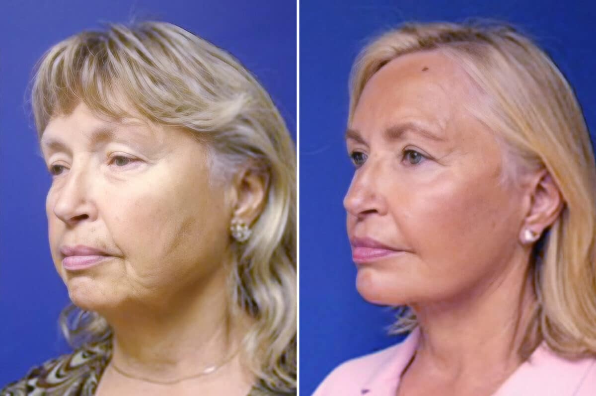 Facelift Before and After Photos in New York, NY, Patient 11307