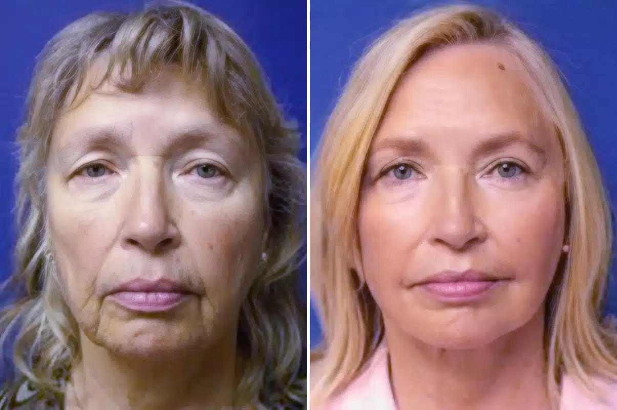 Facelift Before and After Photos in New York, NY, Patient 11307