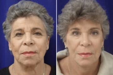 Facelift Before and After Photos in New York, NY, Patient 11354