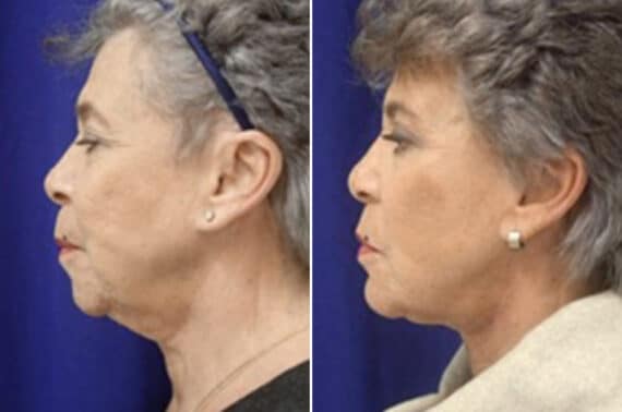 Facelift Before and After Photos in New York, NY, Patient 11354