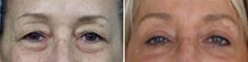 Eyelid Surgery Before and After Photos in New York, NY, Patient 11377