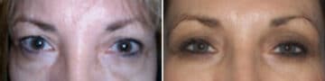 Eyelid Surgery Before and After Photos in New York, NY, Patient 11395