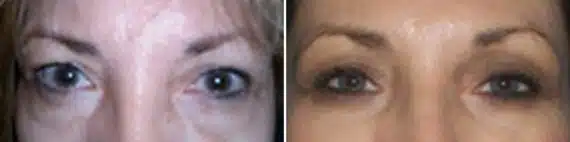 Eyelid Surgery Before and After Photos in New York, NY, Patient 11395