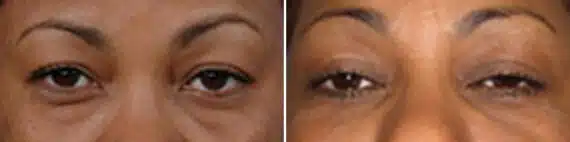 Eyelid Surgery Before and After Photos in New York, NY, Patient 11397