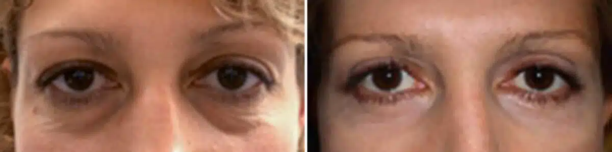 Eyelid Surgery Before and After Photos in New York, NY, Patient 11401