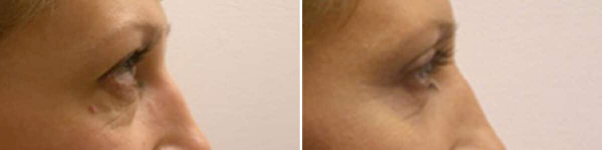 Eyelid Surgery Before and After Photos in New York, NY, Patient 11401