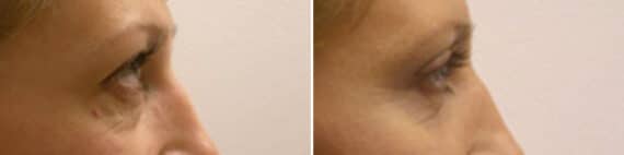 Eyelid Surgery Before and After Photos in New York, NY, Patient 11401