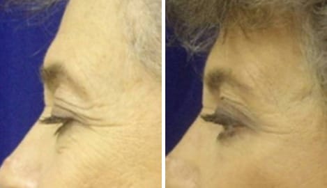 Eyelid Surgery Before and After Photos in New York, NY, Patient 11404