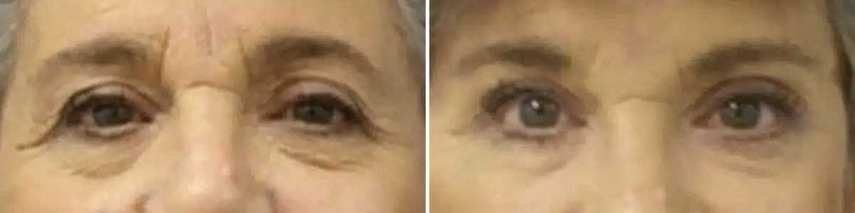 Patient 11404, Eyelid Surgery Before and After Photos Eyelid Surgery Before and After Photos in New York, NY, Patient 11404