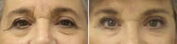 Eyelid Surgery Before and After Photos in New York, NY, Patient 11404