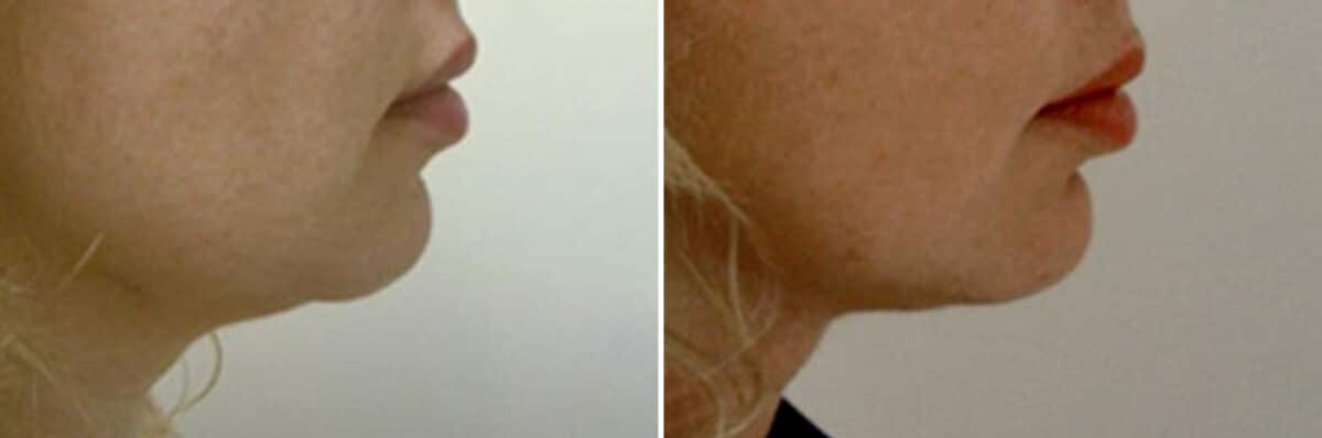 Chin Implant Before and After Photos in New York, NY, Patient 11428