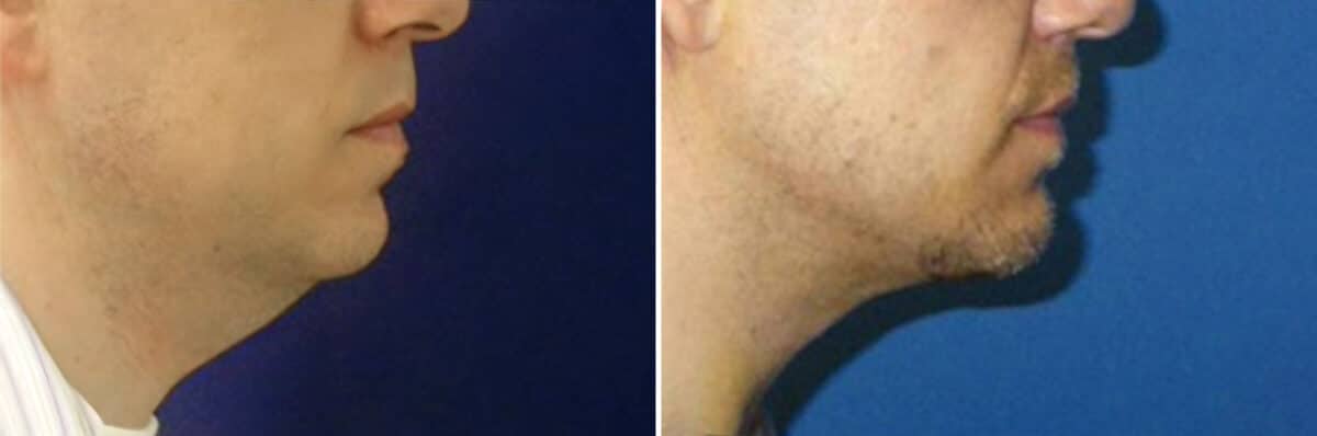 Chin Implant Before and After Photos in New York, NY, Patient 12726