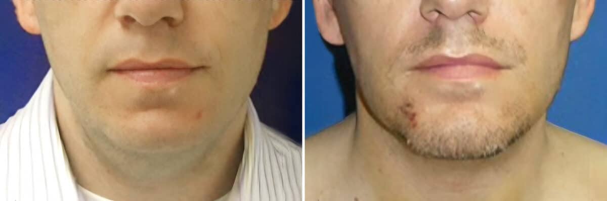 Chin Implant Before and After Photos in New York, NY, Patient 12726