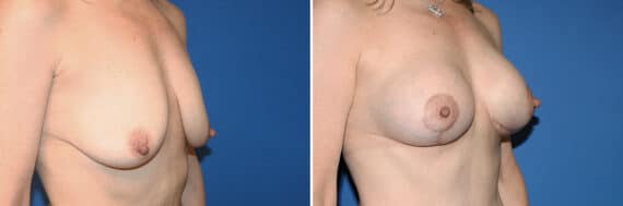 Breast Lift Before and After Photos in New York, NY, Patient 13567