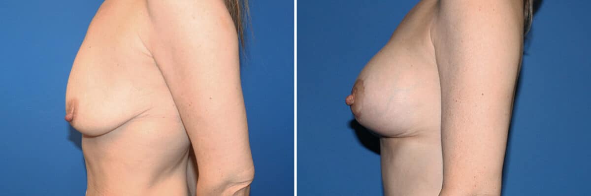 Breast Lift Before and After Photos in New York, NY, Patient 13567