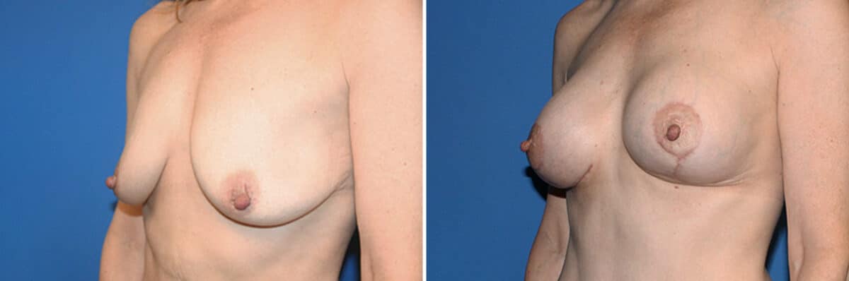 Breast Lift Before and After Photos in New York, NY, Patient 13567