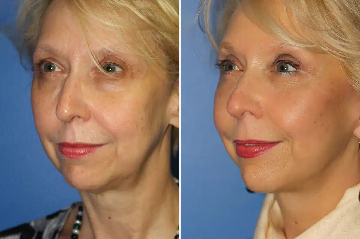 Facelift Before and After Photos in New York, NY, Patient 13855