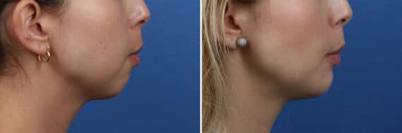 Chin Implant Before and After Photos in New York, NY, Patient 13859