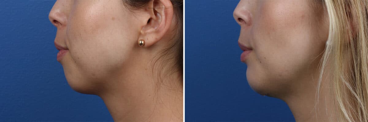 Chin Implant Before and After Photos in New York, NY, Patient 13859