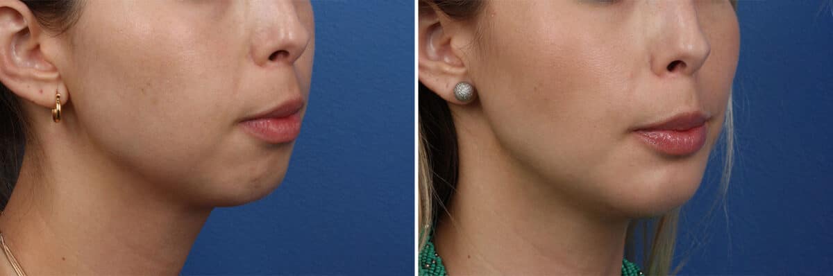 Chin Implant Before and After Photos in New York, NY, Patient 13859