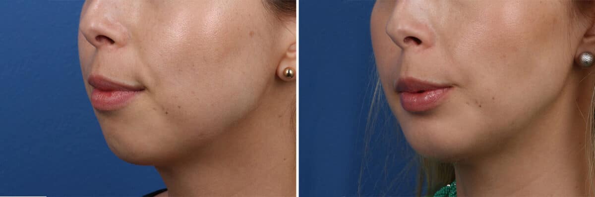 Chin Implant Before and After Photos in New York, NY, Patient 13859