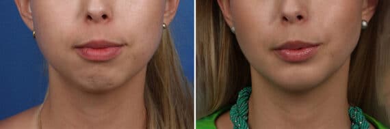 Chin Implant Before and After Photos in New York, NY, Patient 13859