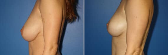 Breast Lift Before and After Photos in New York, NY, Patient 13892