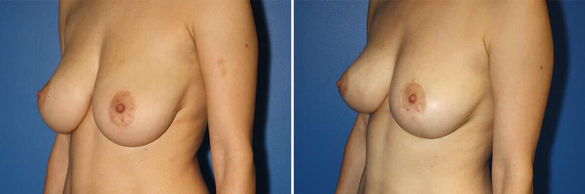 Breast Lift Before and After Photos in New York, NY, Patient 13892
