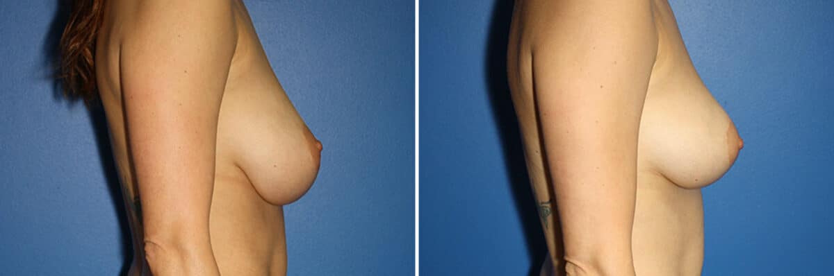 Breast Lift Before and After Photos in New York, NY, Patient 13892