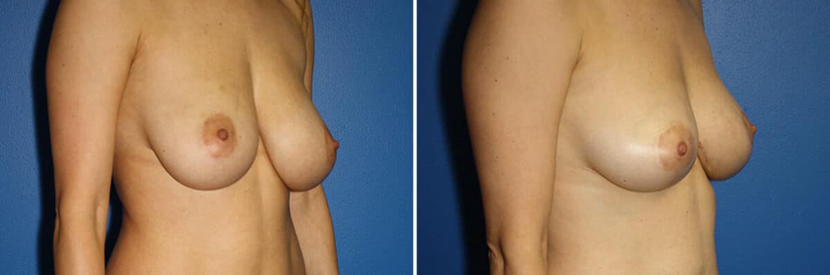 Breast Lift Before and After Photos in New York, NY, Patient 13892