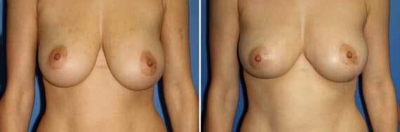 Breast Lift Before and After Photos in New York, NY, Patient 13892