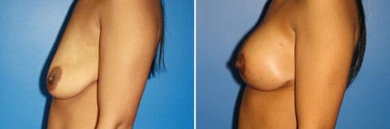 Breast Augmentation Before and After Photos in New York, NY, Patient 13926