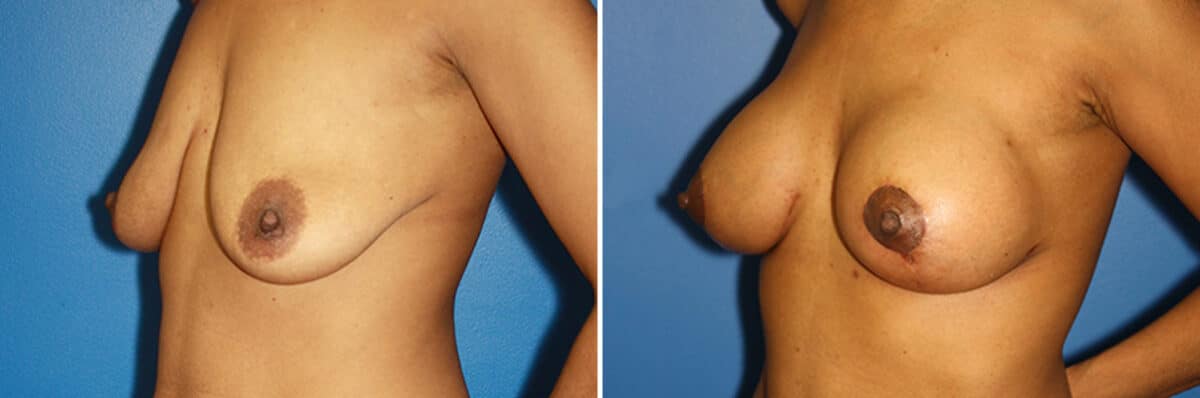 Breast Augmentation Before and After Photos in New York, NY, Patient 13926