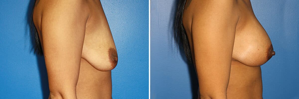 Breast Augmentation Before and After Photos in New York, NY, Patient 13926