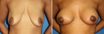 Breast Augmentation Before and After Photos in New York, NY, Patient 13926