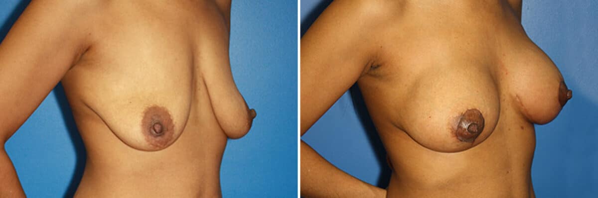 Breast Augmentation Before and After Photos in New York, NY, Patient 13926