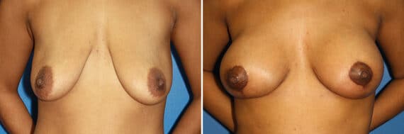 Breast Augmentation Before and After Photos in New York, NY, Patient 13926