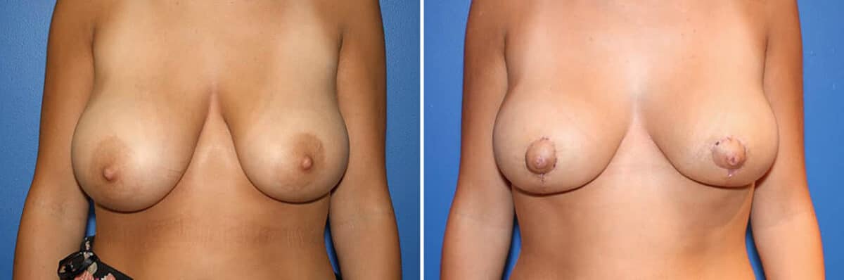 Breast Lift Before and After Photos in New York, NY, Patient 13973