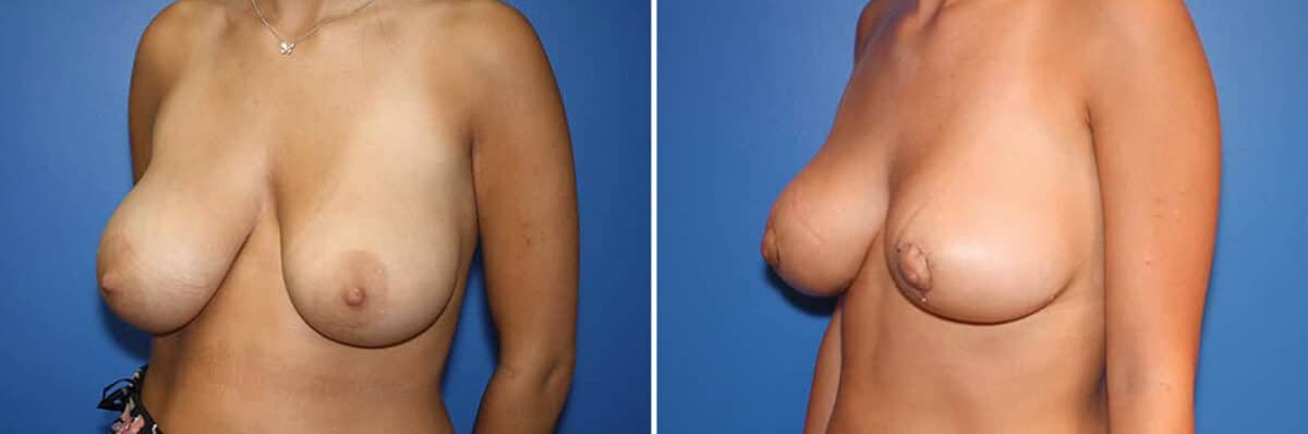 Breast Lift Before and After Photos in New York, NY, Patient 13973