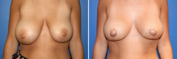 Breast Lift Before and After Photos in New York, NY, Patient 13973