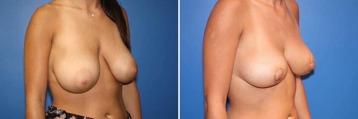 Breast Lift Before and After Photos in New York, NY, Patient 13973