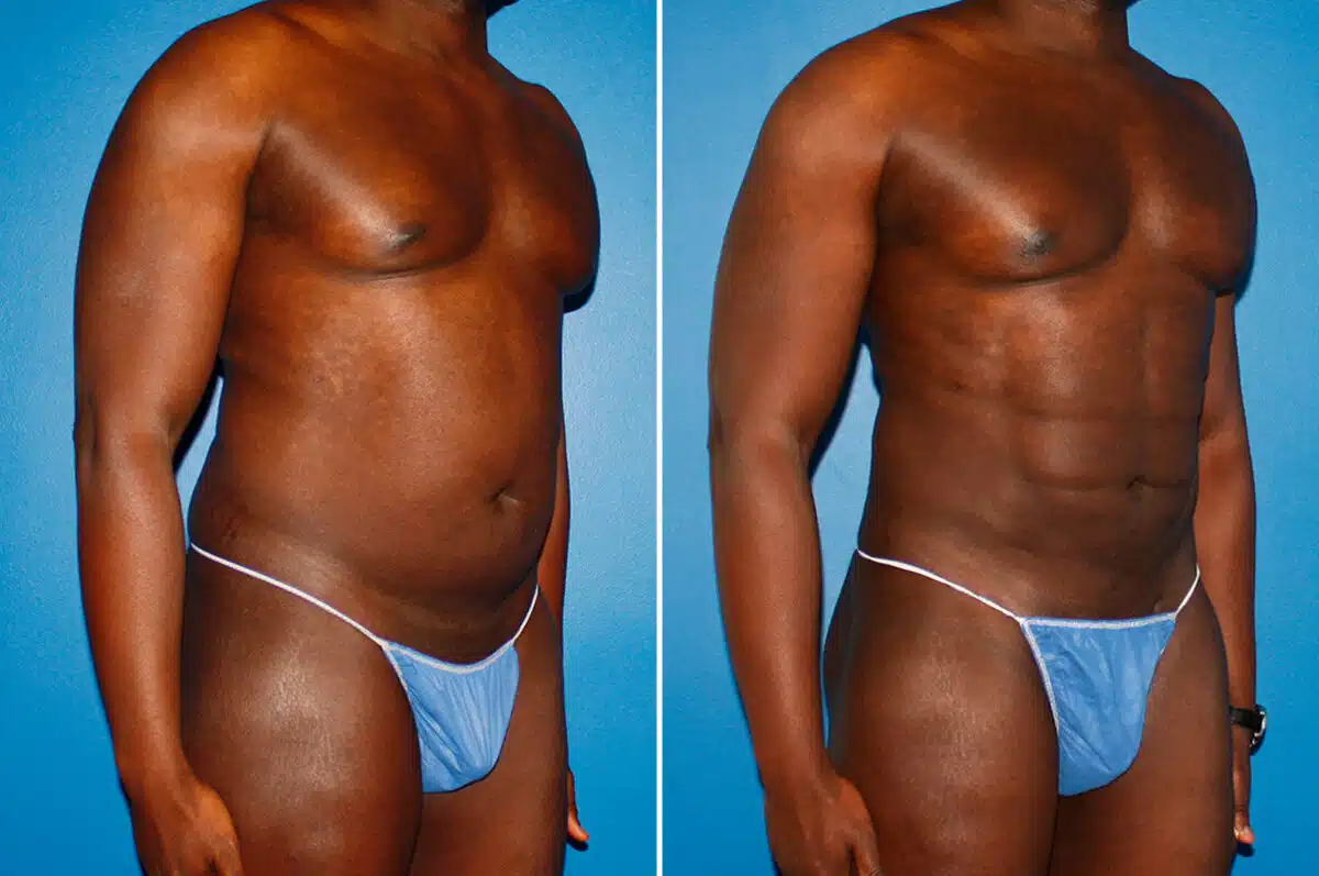 Coolsculpting Before and After Photos in New York, NY, Patient 14167