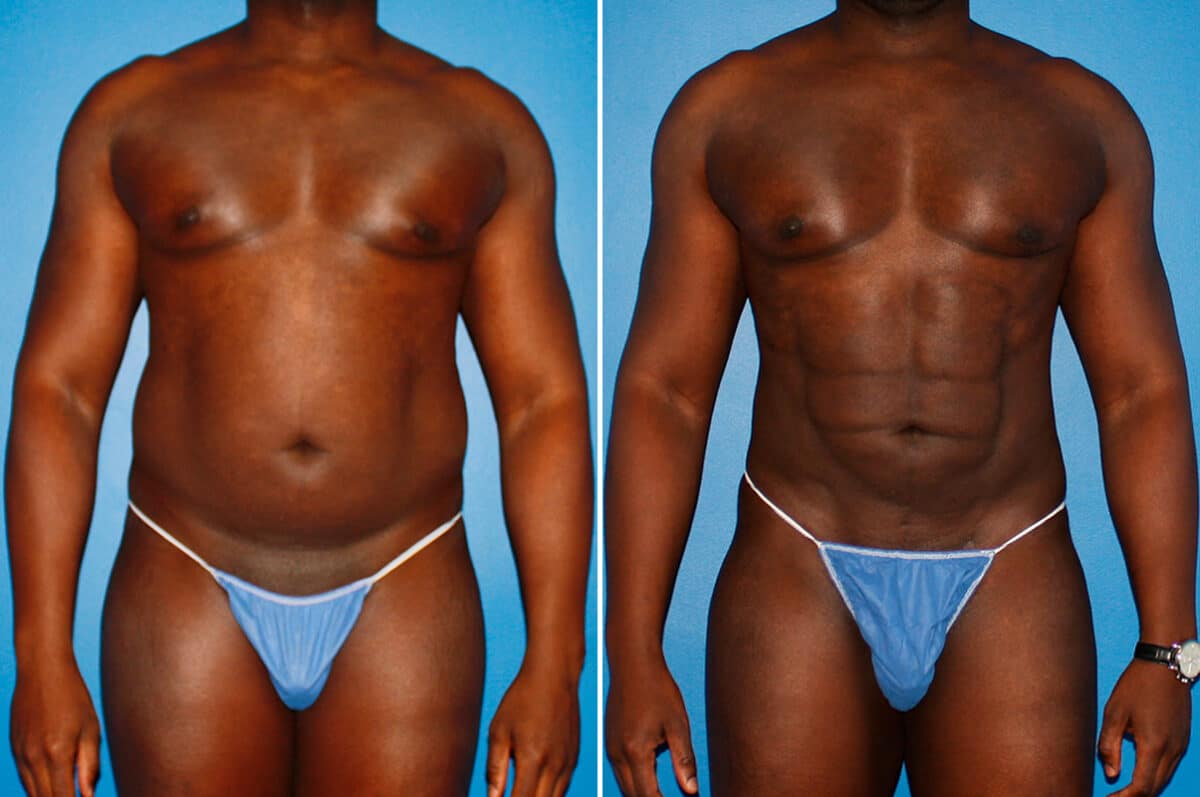 Coolsculpting Before and After Photos in New York, NY, Patient 14167