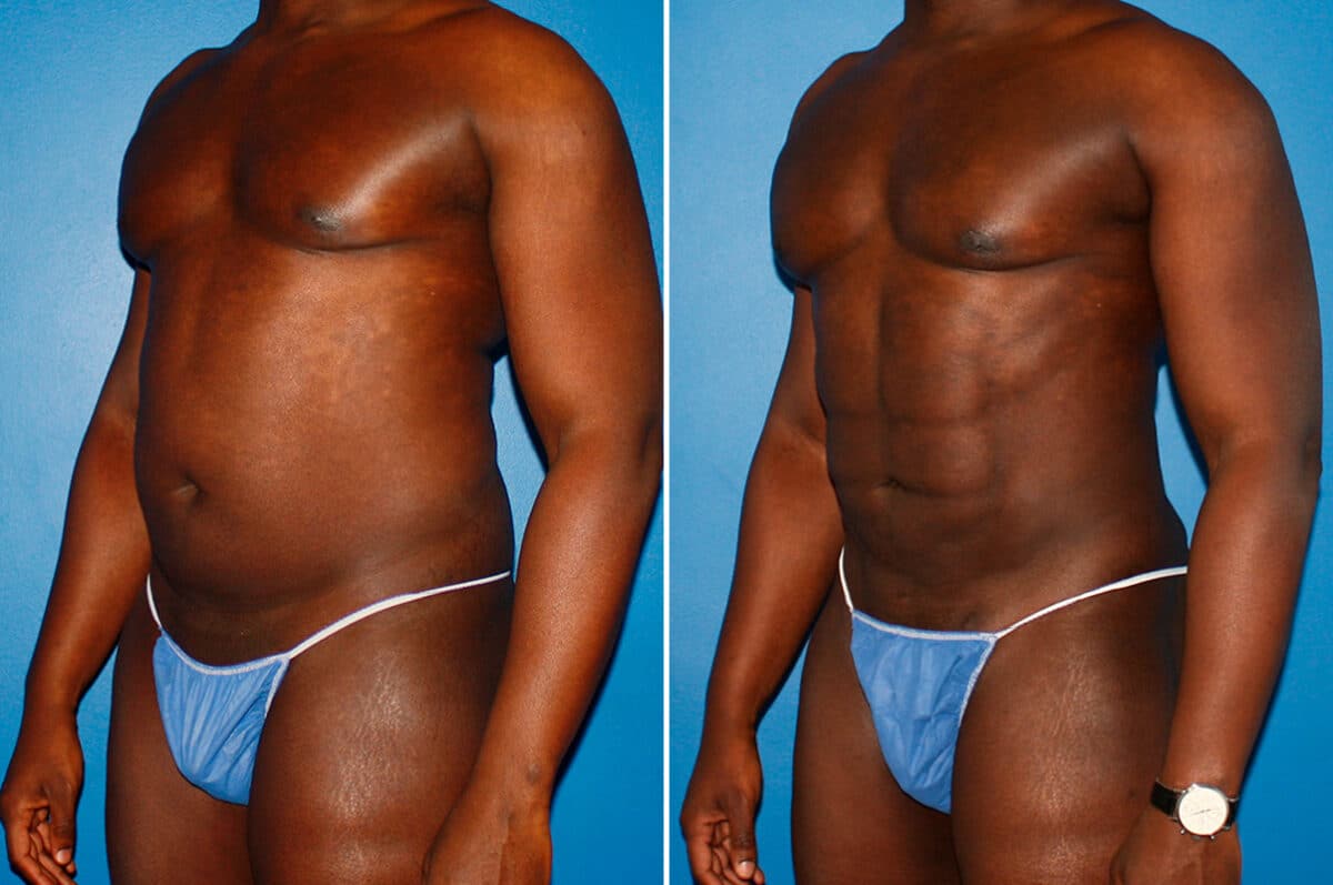 Coolsculpting Before and After Photos in New York, NY, Patient 14167