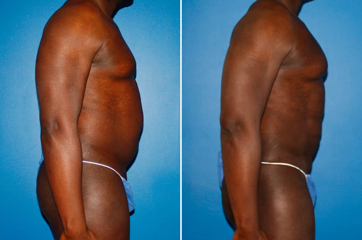 Coolsculpting Before and After Photos in New York, NY, Patient 14167