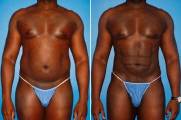 Coolsculpting Before and After Photos in New York, NY, Patient 14167